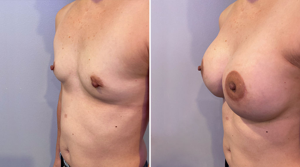 Breast Augmentation