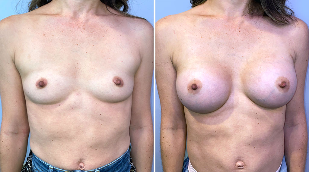 Breast Augmentation