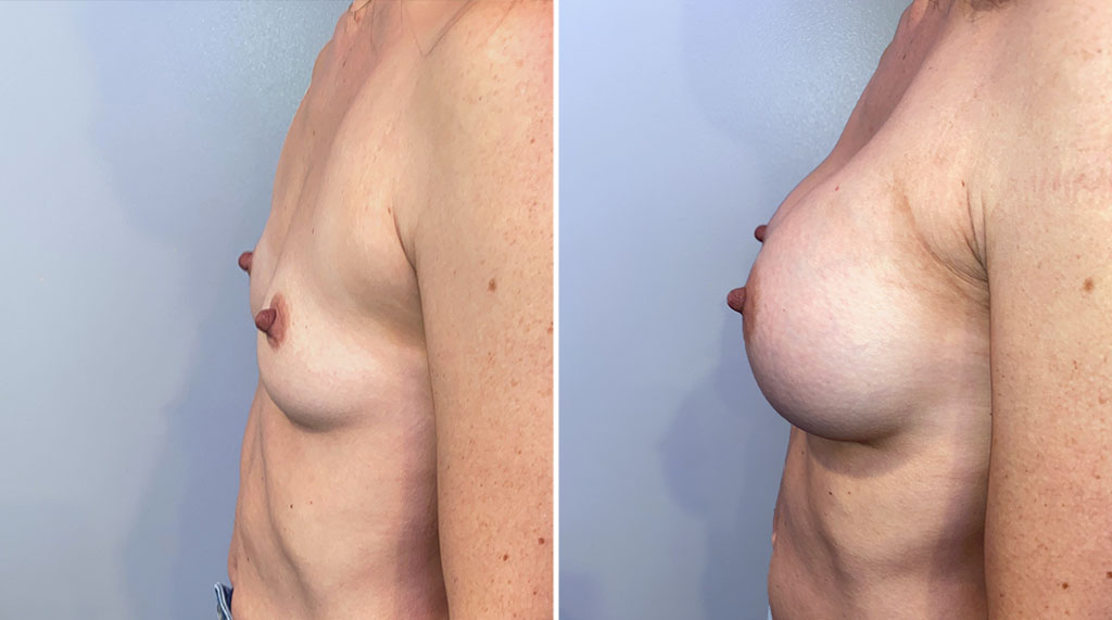 Breast Augmentation