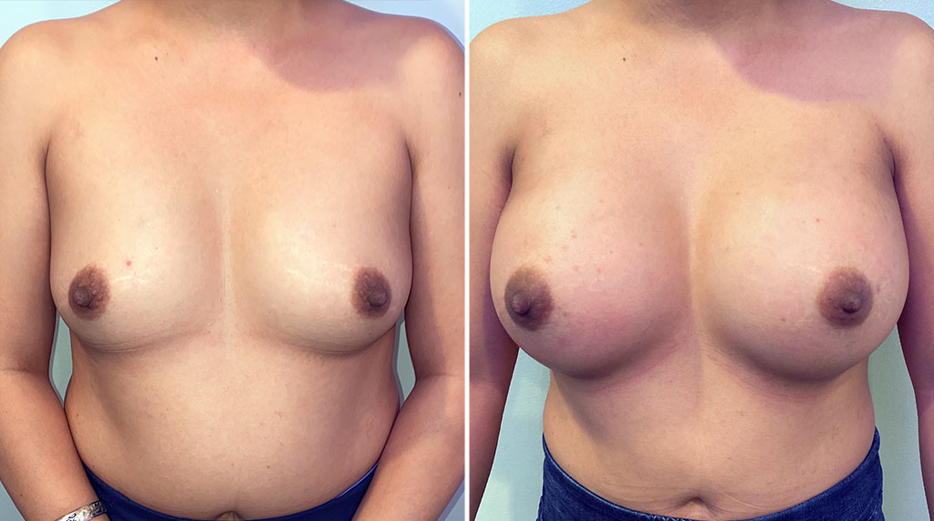 Breast Augmentation