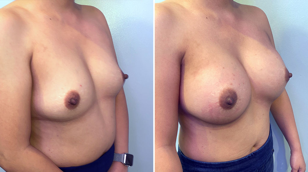 Breast Augmentation