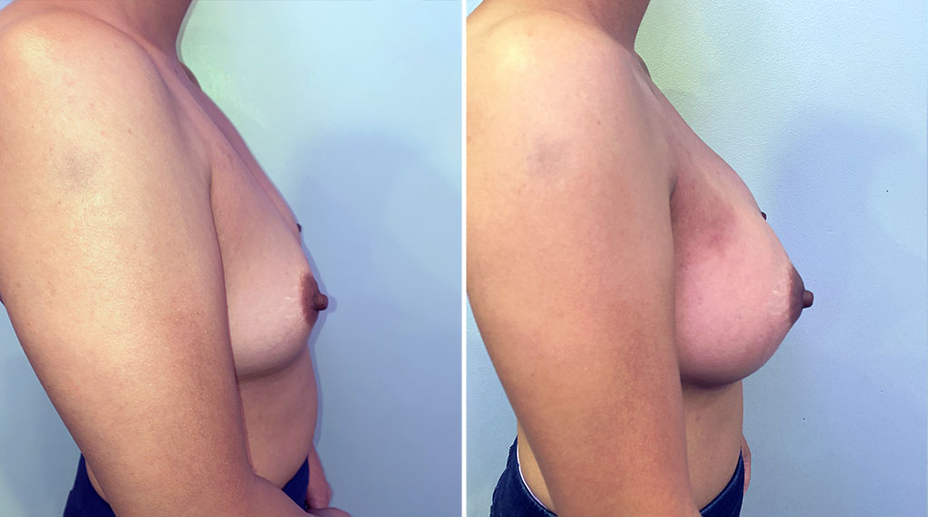 Breast Augmentation