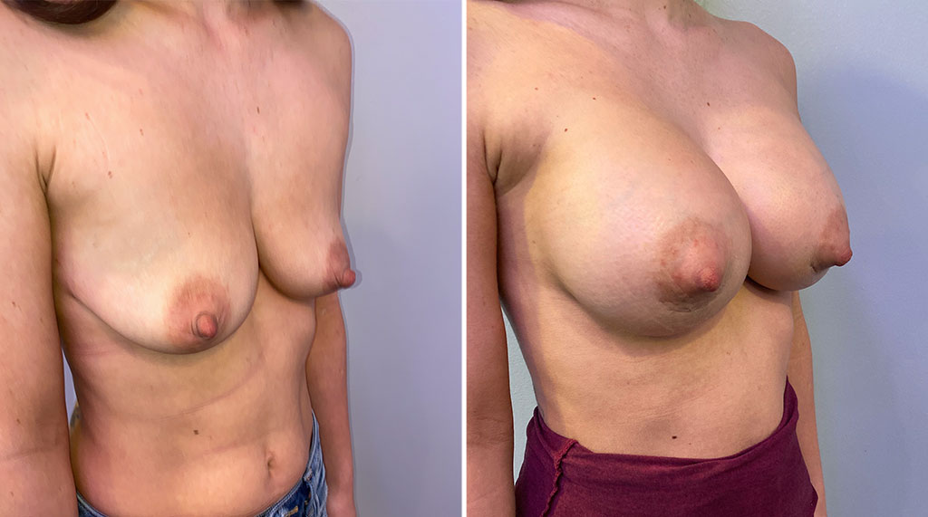 Breast Augmentation