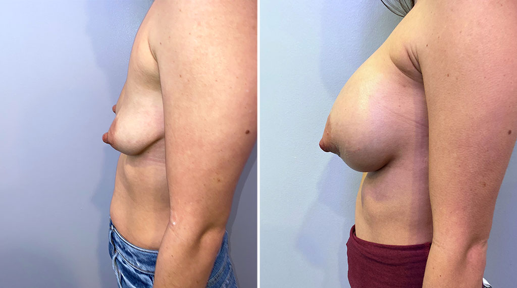 Breast Augmentation