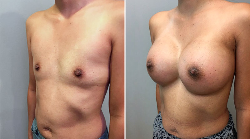 Breast Augmentation