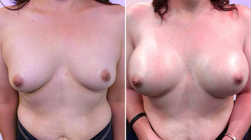 Breast Augmentation