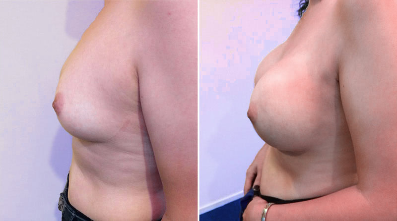 Breast Augmentation