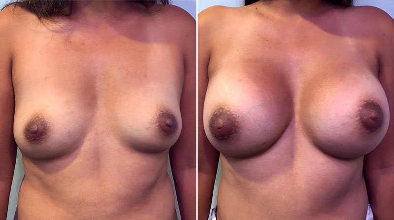 Breast Augmentation