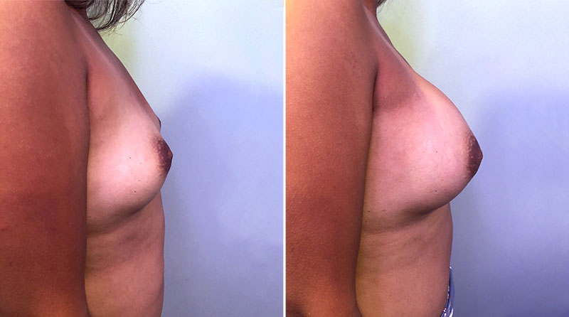 Breast Augmentation