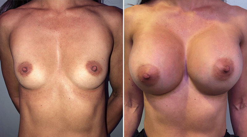 Breast Augmentation