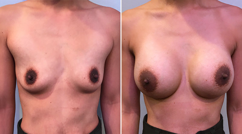 Breast Augmentation