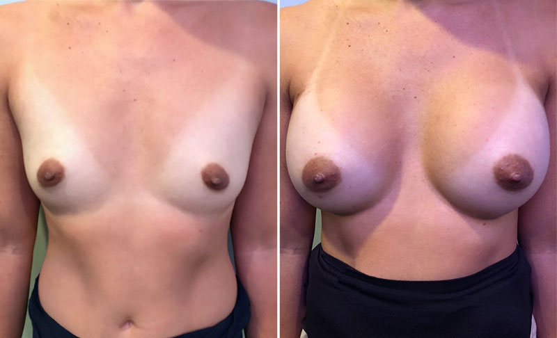 Breast Augmentation