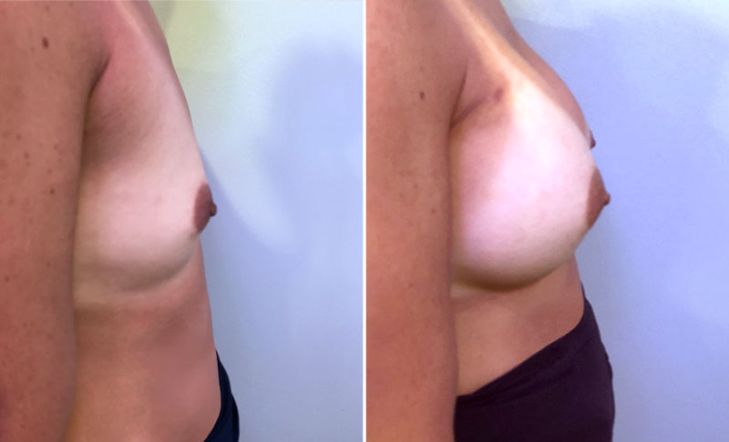 Breast Augmentation