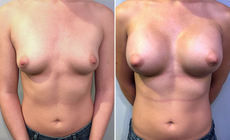 Breast Augmentation