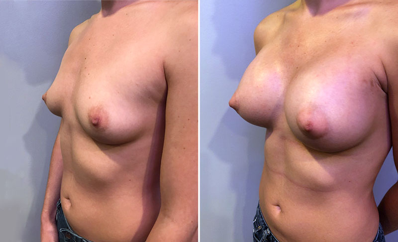 Breast Augmentation