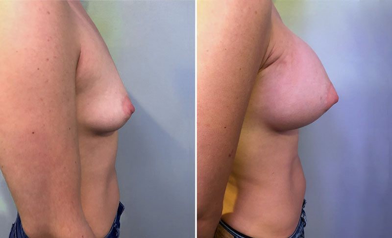 Breast Augmentation