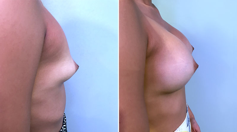 Breast Augmentation