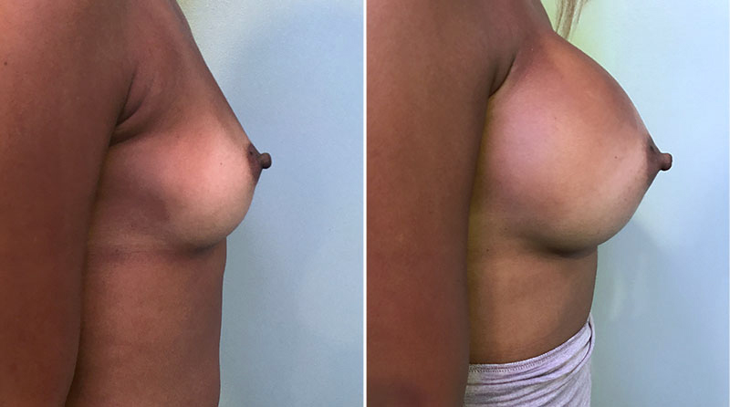 Breast Augmentation