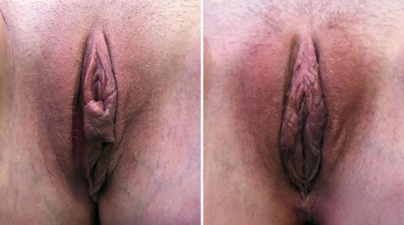 Labiaplasty