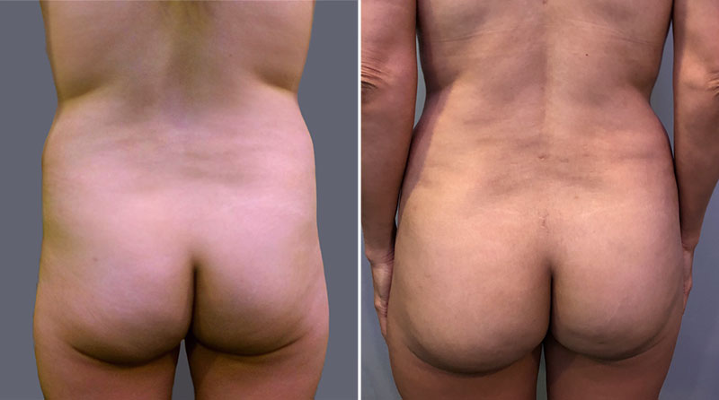 Liposuction