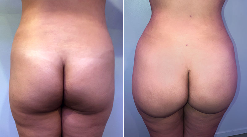 Liposuction