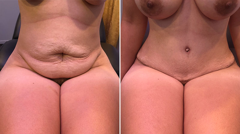 Tummy Tuck