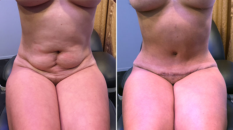 Tummy Tuck