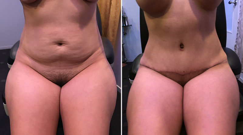 Tummy Tuck