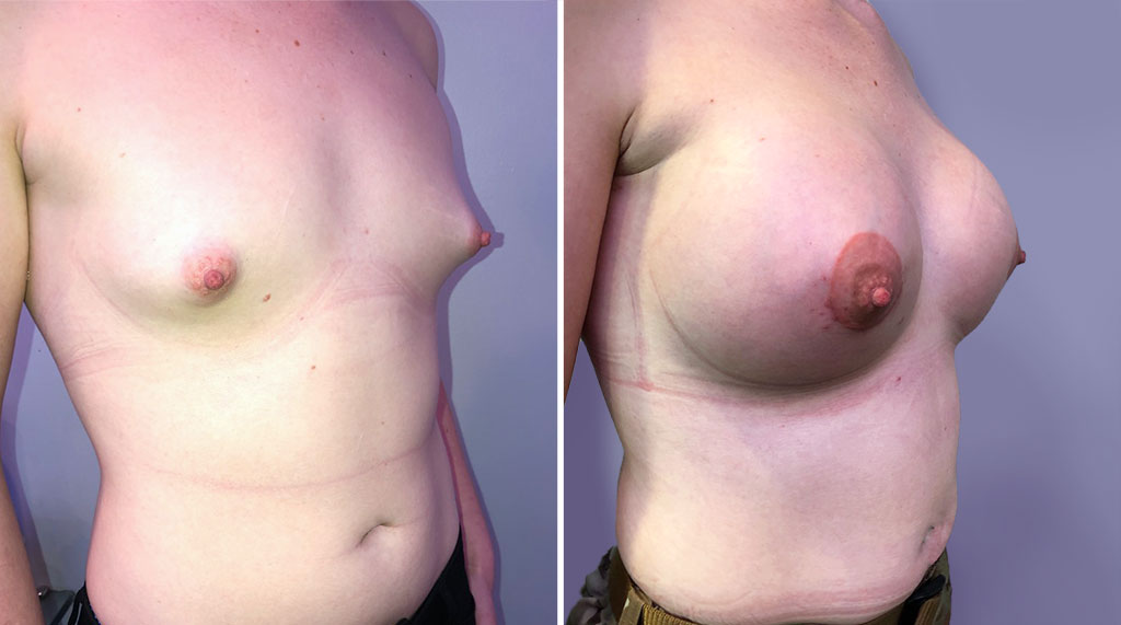 Breast Asymmetry