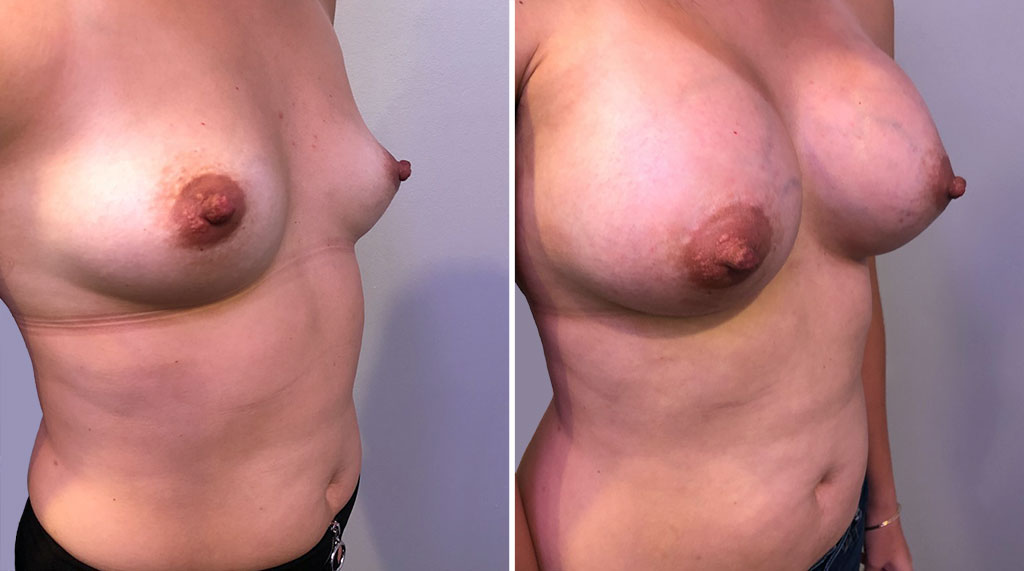 Breast Asymmetry