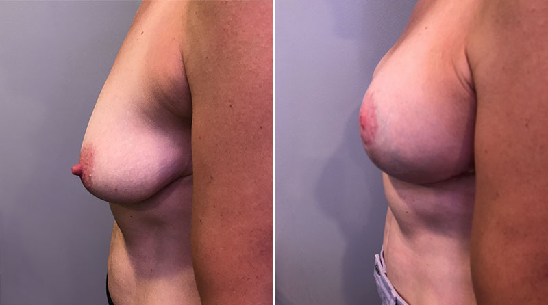 Breast Lift