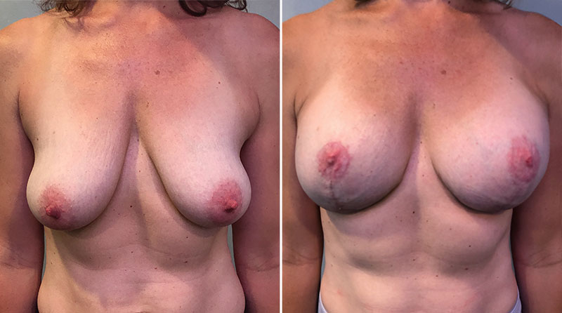 Breast Lift