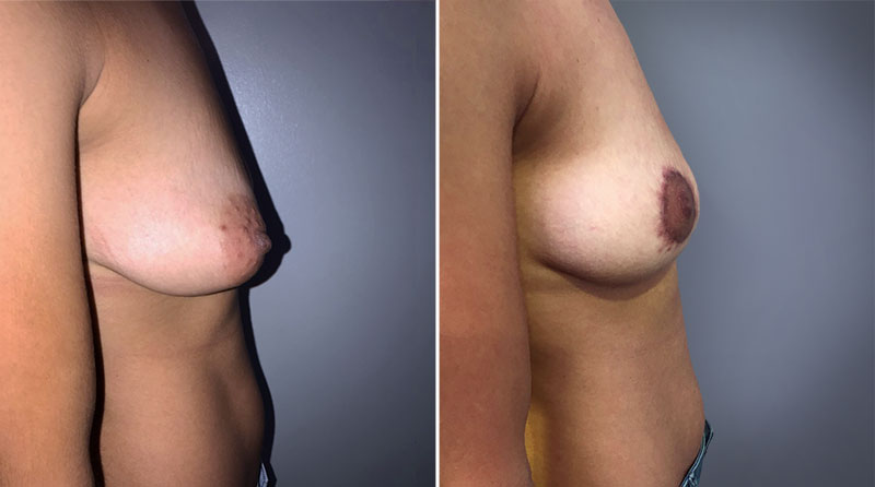 Breast Lift