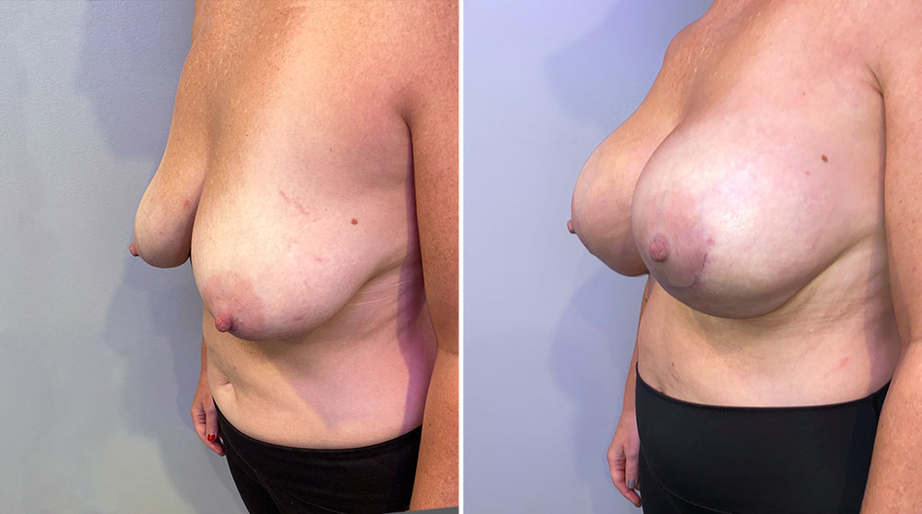 Tuberous Breast Augmentation