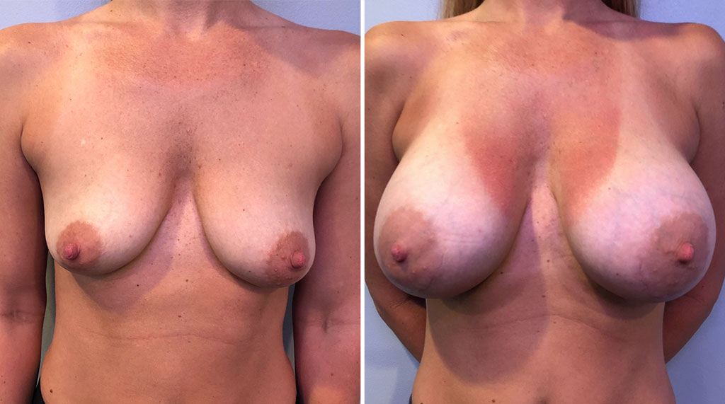 Tuberous Breast Augmentation