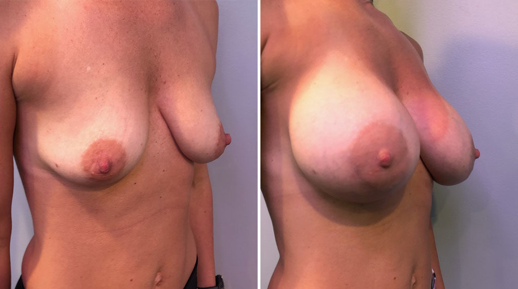 Tuberous Breast Augmentation