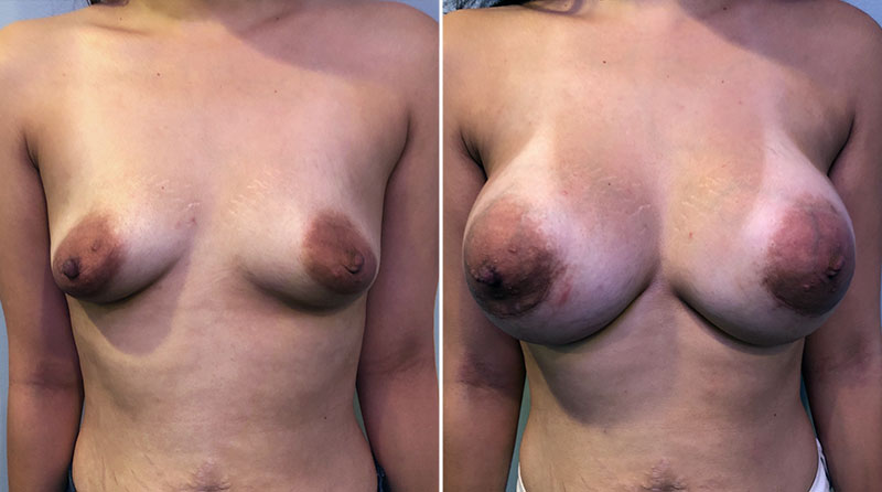 Tuberous Breast Augmentation