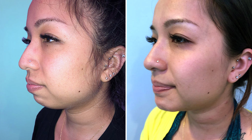 Neck Liposuction