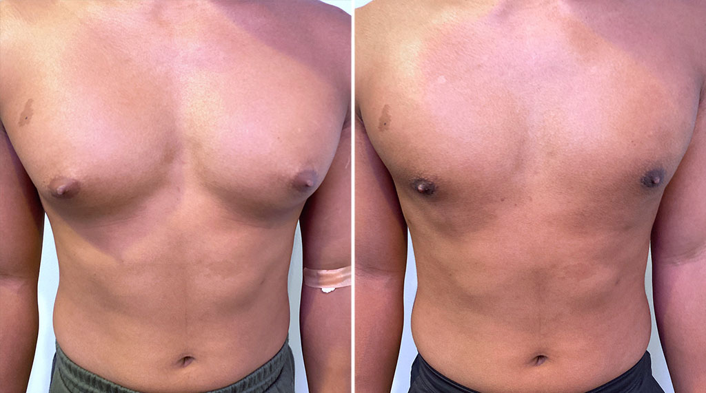 Gynecomastia