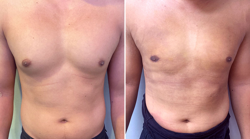 Gynecomastia