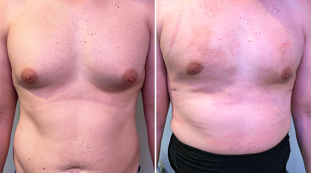 Gynecomastia