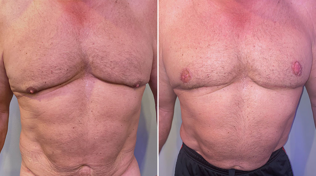 Gynecomastia