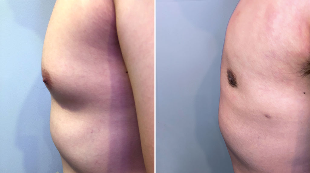 Gynecomastia