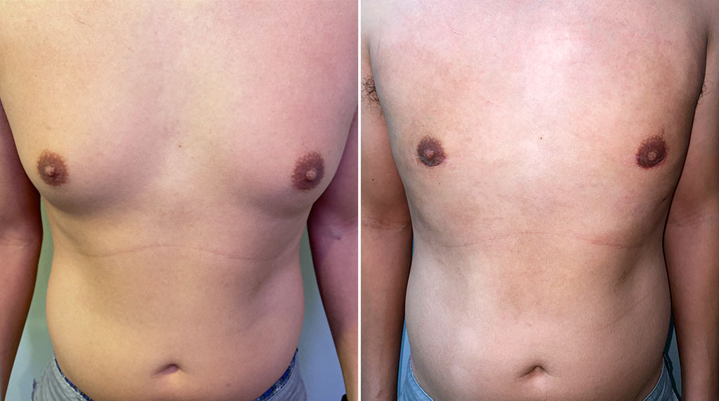 Gynecomastia