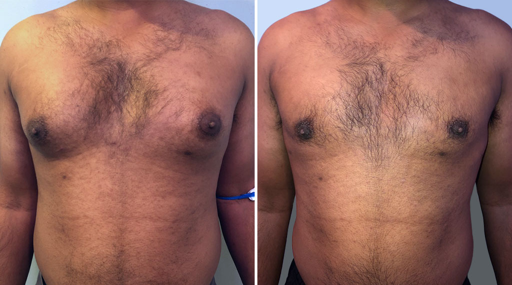 Gynecomastia