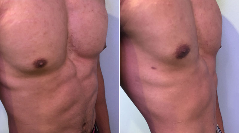 Gynecomastia