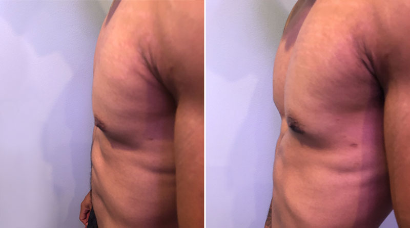 Gynecomastia