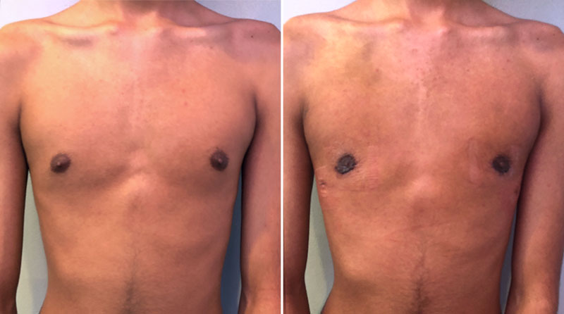 Gynecomastia