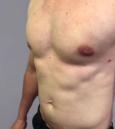 Photo of actual patient after the Gynecomastia procedure