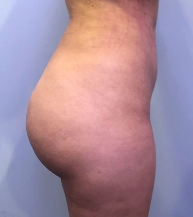 Actual patient after liposuction procedure